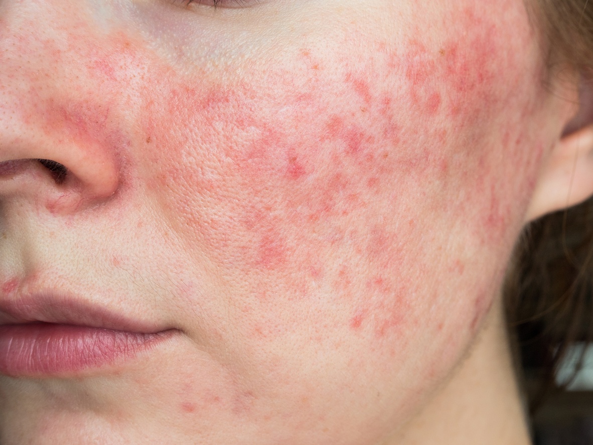 How To Treat Rosacea
